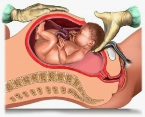 Реабілітація після кесаревого розтину: приблизні терміни, догляд за швом, правила харчування і особливості фізичних навантажень