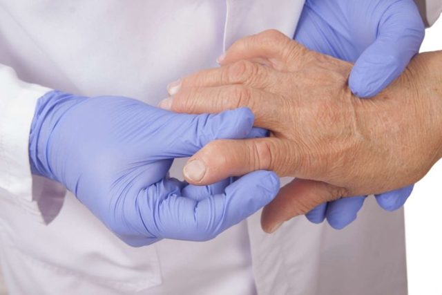Артрит пальців рук: причини, симптоми і лікування, народні засоби