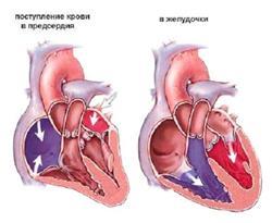 Пороки серця - що це таке, класифікація, причини виникнення, механізм порушення кровообігу