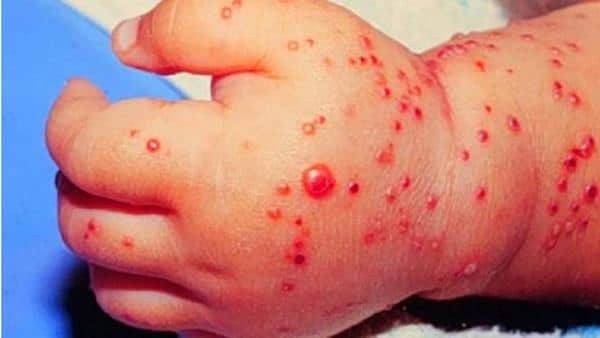Як лікувати атопічний дерматит у дитини 2, 8 років