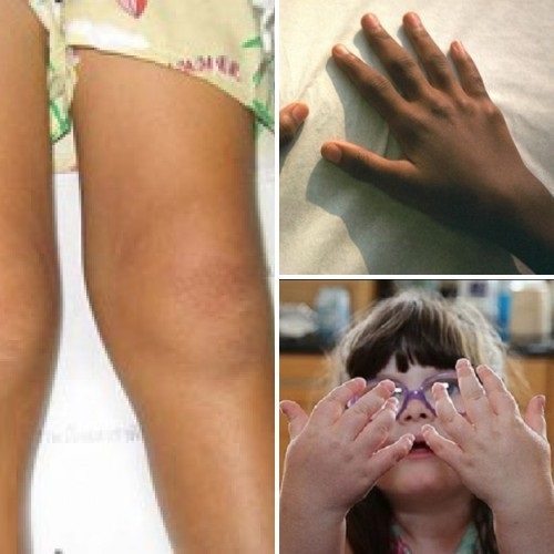 Симптоми і лікування ревматоїдного артриту у дітей