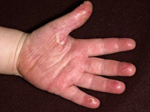 Причини лущення шкіри: що робити, якщо лущиться шкіра на обличчі, на руках, на ногах, лікування лущення шкіри у дітей