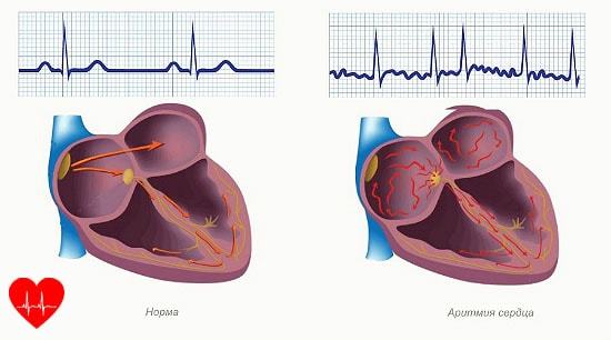 Симптоми порушення серцевого ритму, як відновити нормальний ритм серця
