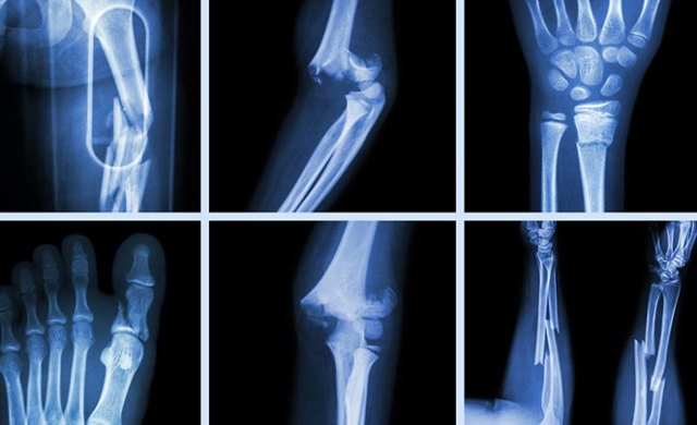 Як визначити перелом ребра по рентгенівському знімку: розшифровка рентгена
