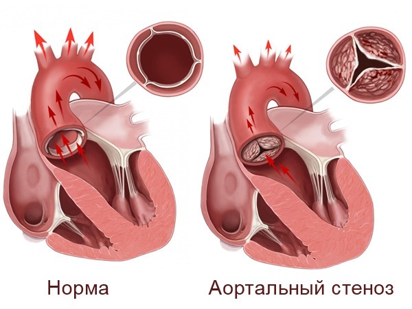Аортальний стеноз - симптоми, лікування, діагностика, операція при стенозі аорти