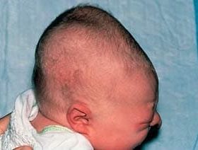 Кефалогематома у новонароджених: причини появи, характерні прояви, принципи лікування та можливі ускладнення