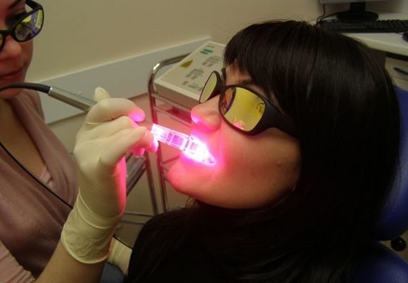 Лазерне відбілювання зубів: плюси і мінуси, відмінності лазерного і фотовідбілювання.