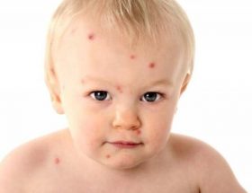 Алергія у грудної дитини: симптоми у дітей до 1 року і новонароджених, діагностика і лікування
