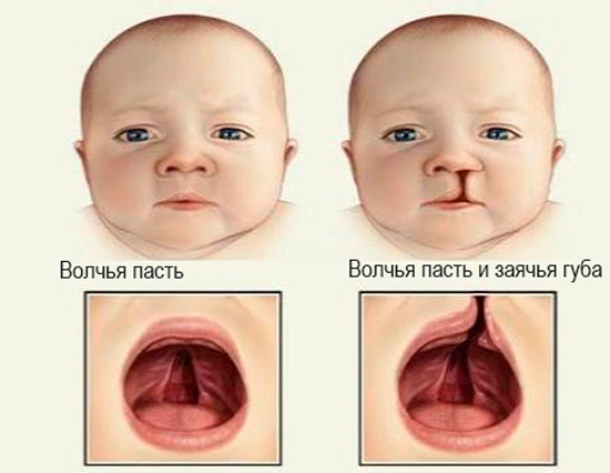 Заяча губа: причини виникнення, що робити, заяча губа до і після операції