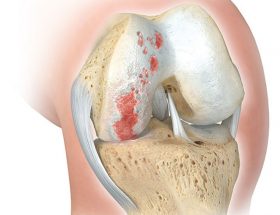 Як виявити і лікувати артралгія колінного суглоба в домашніх умовах?