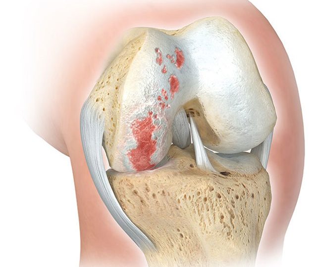 Як виявити і лікувати артралгія колінного суглоба в домашніх умовах?
