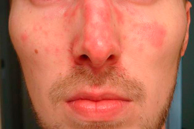 Як проявляється алергія на алкоголь і чому з'являються червоні плями на обличчі