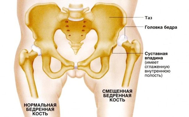 Дисплазія тазостегнових суглобів у дітей: симптоми, причини розвитку, лікування дисплазії ТБС, масаж і гімнастика при дисплазії тазостегнових суглобів  