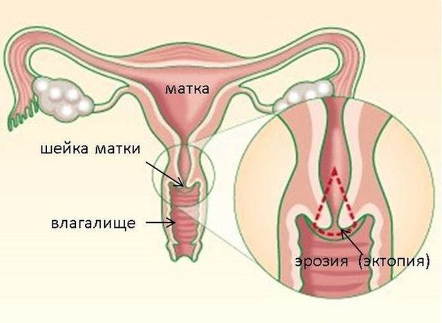 Що таке ерозія шийки матки і чим вона небезпечна