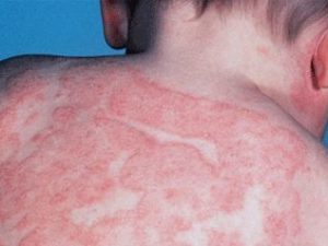Суха і шорстка шкіра у дитини: чому лущиться шкіра, лікування сухої шкіри у дітей