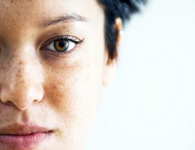 Пігментні плями на обличчі: причини виникнення, найефективніші методи лікування