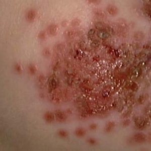 Про яку хворобу говорить висипання бульбашок на шкірі?