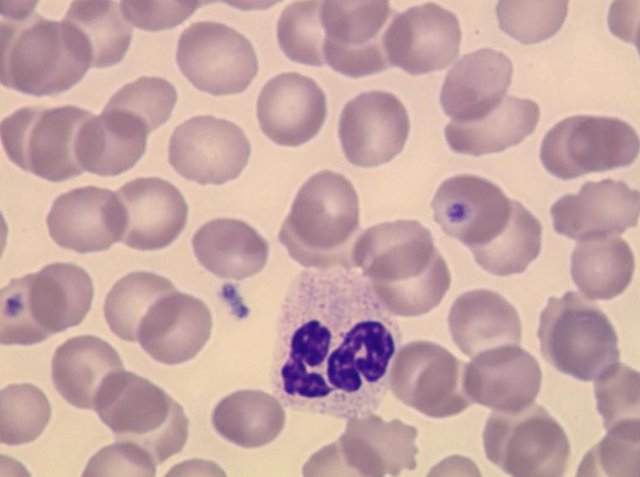 Чому підвищені лейкоцити в крові: причини і лікування