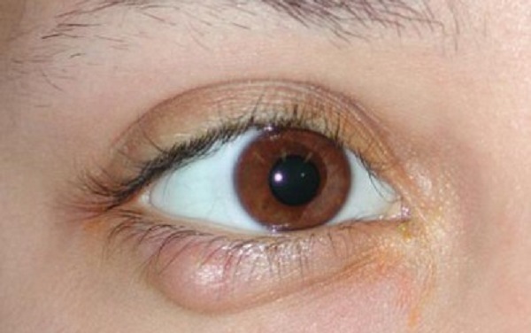 Як лікувати чиряк на оці, лікування фурункула на оці