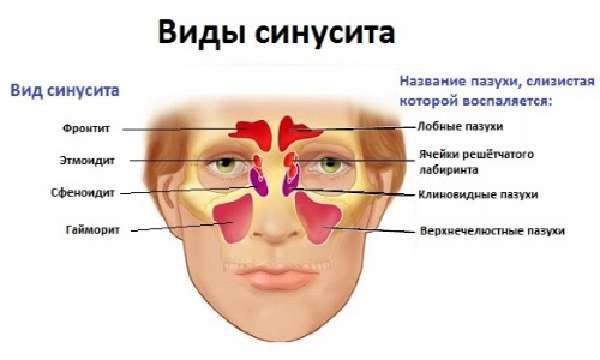 Гнійний синусит: симптоми, причини і лікування