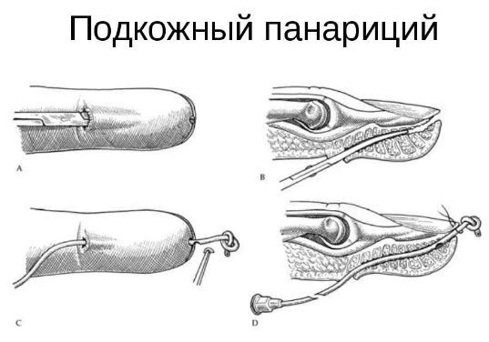 Кістковий панарицій великого пальця кисті: причини, симптоми, лікування