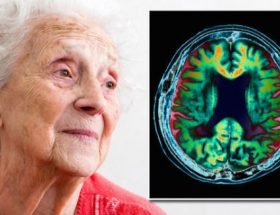 Стареча деменція: причини розвитку, перші ознаки і специфічні симптоми, методи лікування недоумства
