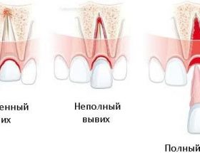 Вколоченний, повний і неповний вивих зубів: причини травм, характерні ознаки, лікування та можливі ускладнення