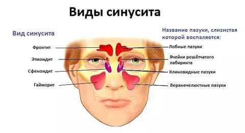 Гіперпластичний риніт, гайморит, синусит і риносинусит: симптоми і лікування