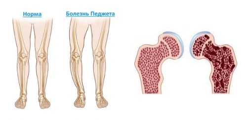 Деформуючий остеит кісток або хвороба Педжета: що це, симптоми і лікування