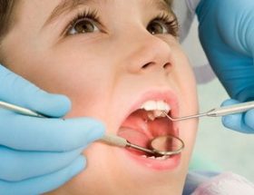 Гранулема зуба: стадії розвитку захворювання, основні ознаки, особливості лікування