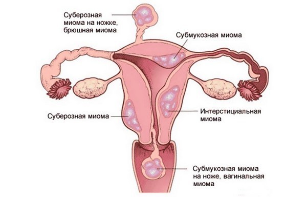 Міома матки: видалення, операція, методи лікування міоми матки малих розмірів