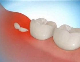 Зростає зуб мудрості і болить ясна: лікувати або видаляти, якщо зуб росте в бік, в щоку