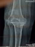 Парапротезних інфекція тазостегнового, колінного суглоба: симптоми, лікування