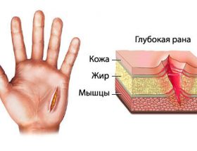 Чим обробити фалангу пальця, якщо відірвало шматок шкіри?