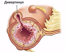 Хворобливе ущільнення в животі у жінок: можливі причини і методи діагностики 