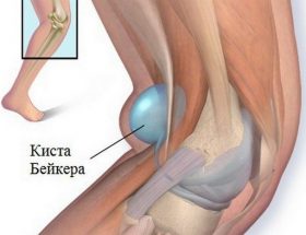 Кіста Бейкера колінного суглоба, під коліном: причини виникнення, характерні симптоми, діагностика та лікувальні заходи
