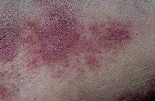 Гемосидероз шкіри ніг, тіла: симптоми, лікування хвороби Шамберга у жінок і чоловіків