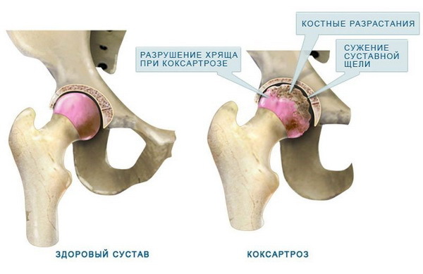 Відкритий перелом стегнової кістки зі зміщенням та без: перша допомога, терміни відновлення