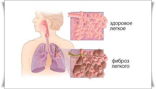 Фіброз легенів: що це таке і як лікувати, симптоми фіброзу легенів і лікування