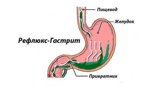 Гіпертрофічний гастрит шлунка: що це таке, симптоми, лікування