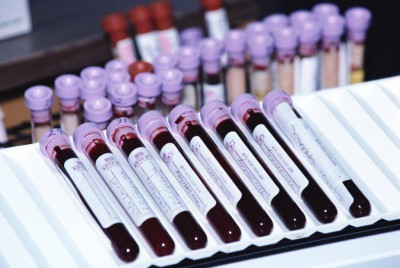 Аналіз крові на кір: як називається, як здавати, лабораторна діагностика кору