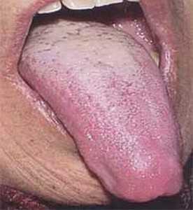 Причини сухості в роті: при якій хворобі з'являється, чому пересихає в роті
