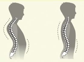 Кіфоз у дітей: симптоми, лікування, діагностика, причини і профілактика