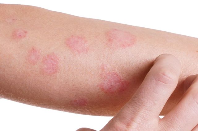Алергія на мед: виникнення, симптоми і діагностика