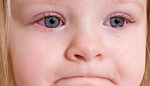 Гострий риніт у дітей: симптоми і лікування захворювання