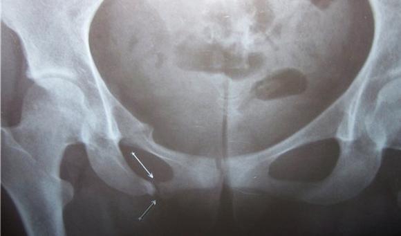 Перелом кісток тазу: невідкладна допомога, наслідки, скільки триває лікування