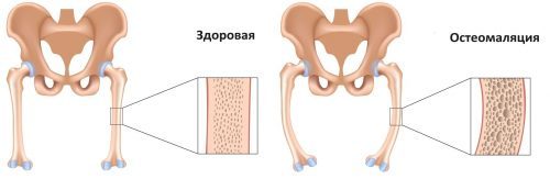 Остеомаляція стегнової кістки, берда: причини, симптоми, лікування, профілактика