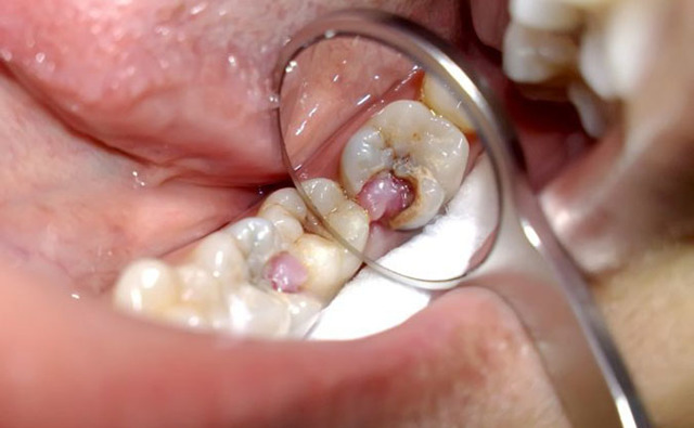 Пульпіт зуба: що це таке, як лікують пульпіт, хронічний і гострий пульпіт