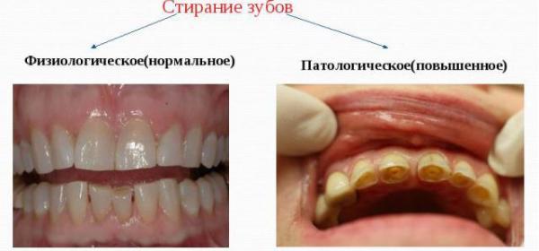 Підвищена стираемость зубів: що робити, якщо стирається емаль зубів