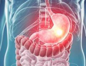 Безоар шлунка у людини: види захворювання і причини появи, характерні симптоми і принципи лікування
